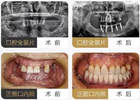 泽美口腔种植牙靠谱吗？资深牙医和正规资质帮你分析