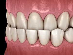 排名速看：常州口腔种植牙哪个医院好“透明公开”即拔即种种植牙的利与弊