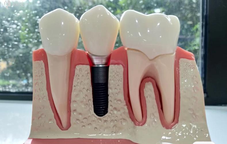 老年缺牙修复方式_传统活动假牙选择_君成口腔门诊部假牙价格