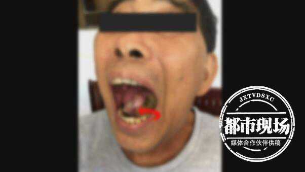 中山大学附属口腔医院口腔颌面外科 中山大学口腔医院颌面外科：3年溃疡险致命，专家揭秘口腔癌警示信号