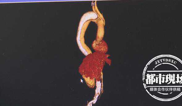 口腔溃疡舌癌_舌癌症状与治疗_中山大学附属口腔医院口腔颌面外科