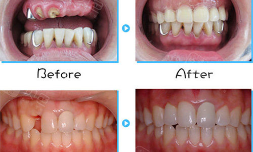 西安诺贝尔口腔连锁种植牙