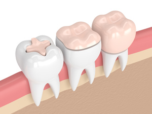 东莞南城众芽口腔吴君让医生牙齿种植技术测评:从操作到效果全面解析!