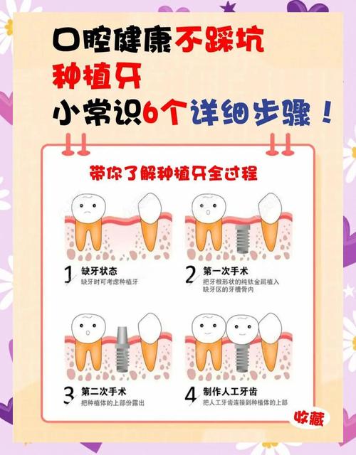 东莞南城众芽口腔种植牙_吴君让医生种植技术_东莞南城优梨口腔门诊部