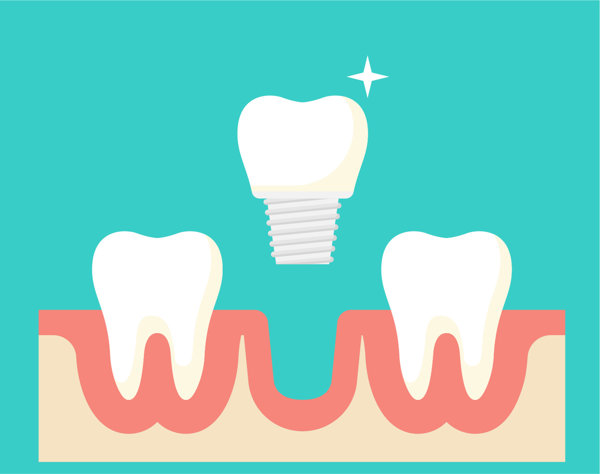 种植牙瑞典nobel价格多少钱