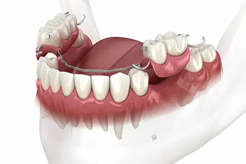 活动义齿示意图